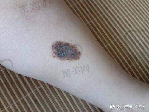 真人实例：见证北京广济医院陈业忠胎记治疗奇迹