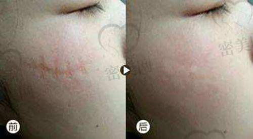 激光美容科设备配置如何？有没有市面“爆款仪器”？