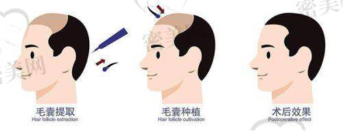 刘晨医生技术特点：