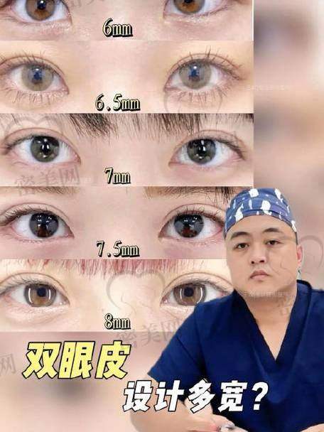 上海伯思立整形：做双眼皮的理想之选
