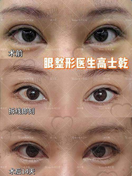 “吕方中只接简单修复”？打脸！他做过的三修失败眼占比21%