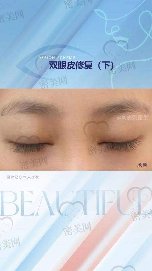上海伯思立整形徐晓斐：16000 起的双眼皮修复，价格香到爆！
