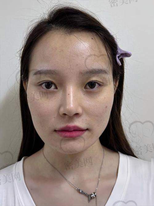 卧蚕填充价格知多少