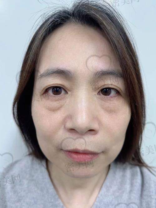 给正在纠结是否动手术祛眼袋的你——选择深圳美诗沁港丹的几个理由