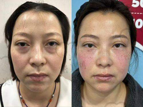 深圳美诗沁不开刀祛眼袋术后真实修复周期一览