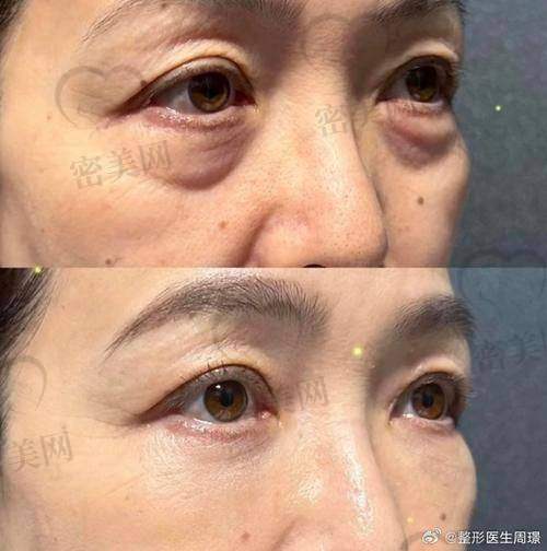 不开刀祛眼袋技术特点——深圳美诗沁港丹有什么不一样？