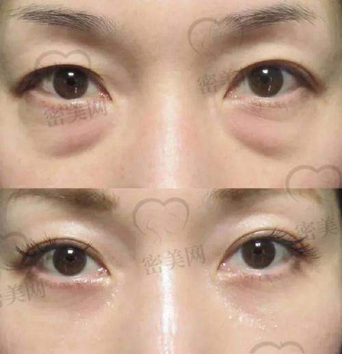 用户口碑如何？杭州健丽祛眼袋靠谱吗？