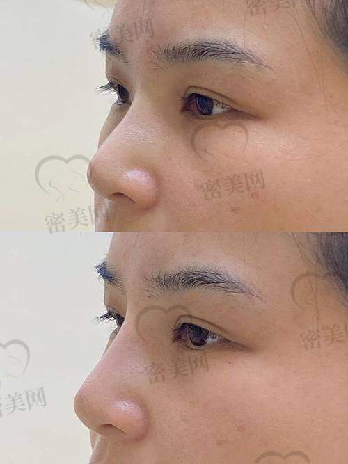 上海许炎龙鼻子风格什么样？收费标准大公开