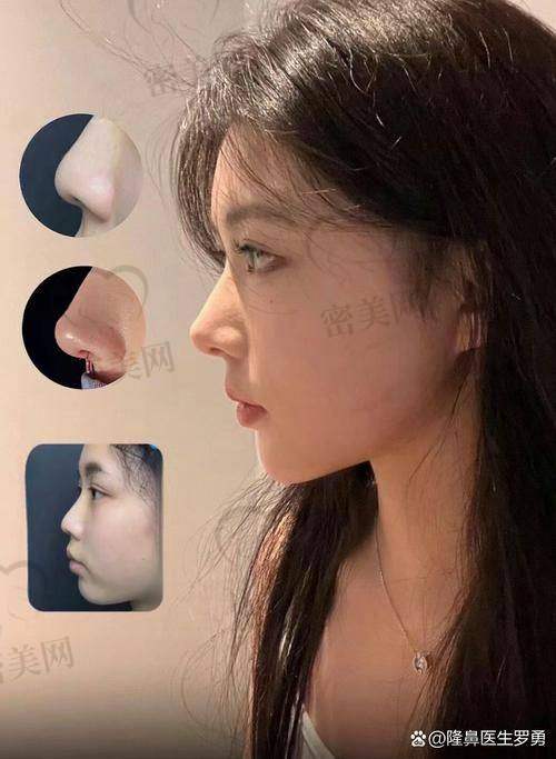 北京沃尔医院赵丹肋软骨隆鼻：5万起的美鼻“神价”