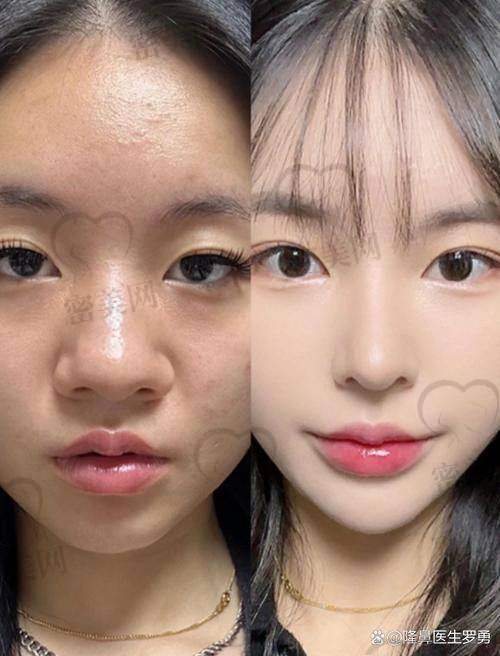 上海许炎龙鼻子风格什么样？经典实例超惊艳