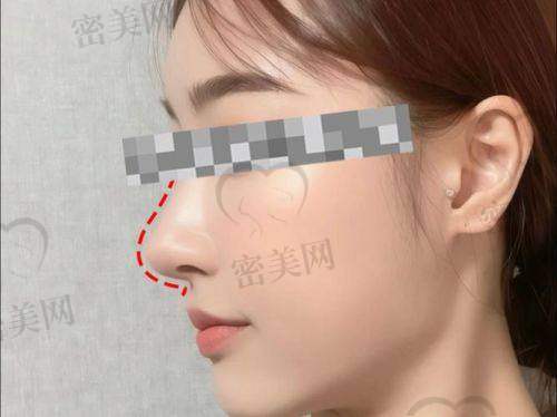 肋软骨隆鼻的优势：美鼻的“秘密武器”