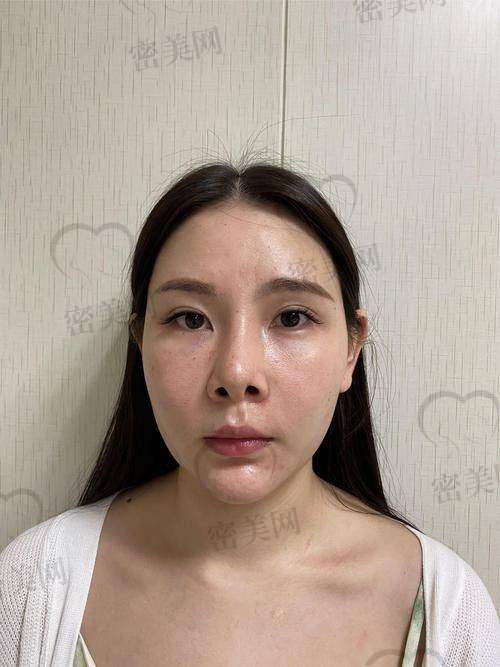 上海伯思立整形王玲鼻修复：真人实例见证奇迹