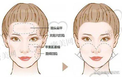 填充太阳穴凹陷的风险与注意事项