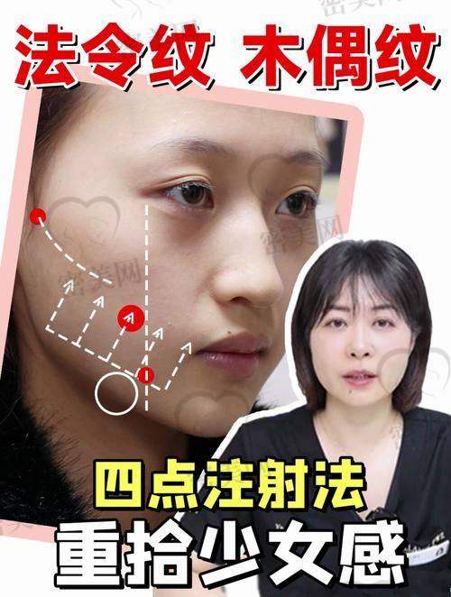 玻尿酸填充法令纹的注意事项