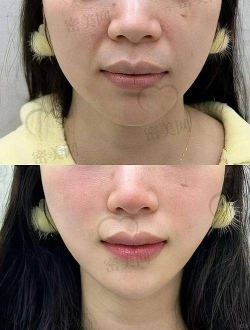 不同年龄段适合的整形项目