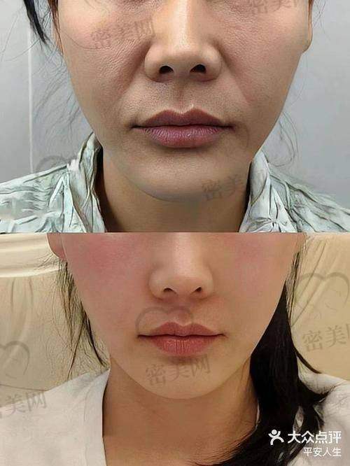成效能维持多久？