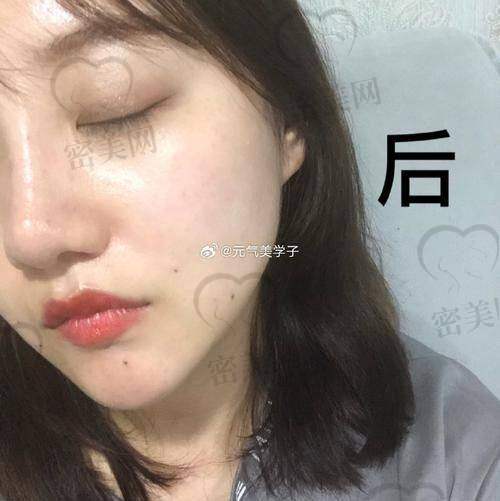 常见医美项目推荐