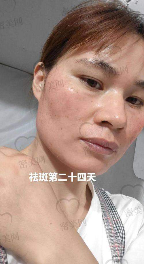 广州红十字会医院其他热门皮肤美容项目费用整理