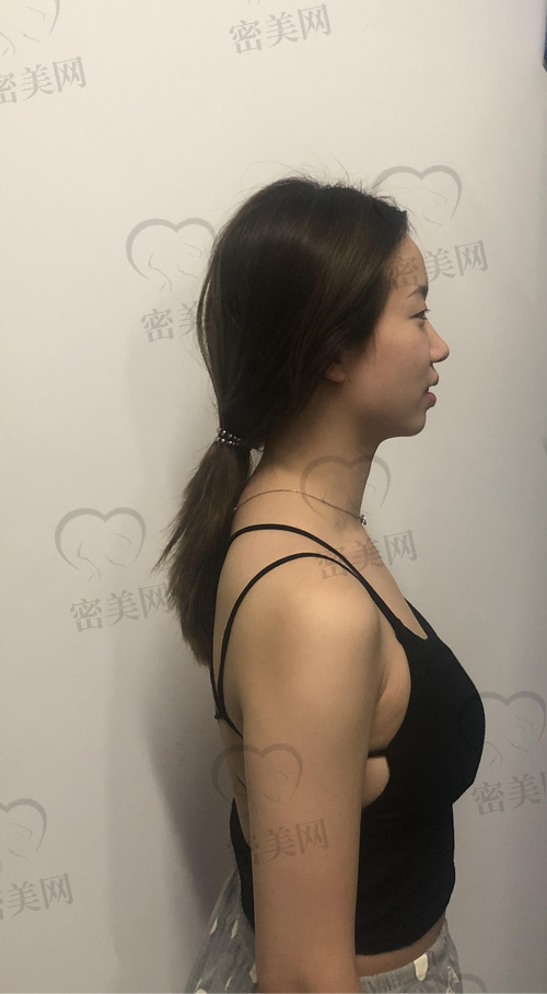 刘志刚院长假体隆胸价格贵吗？值得做吗？