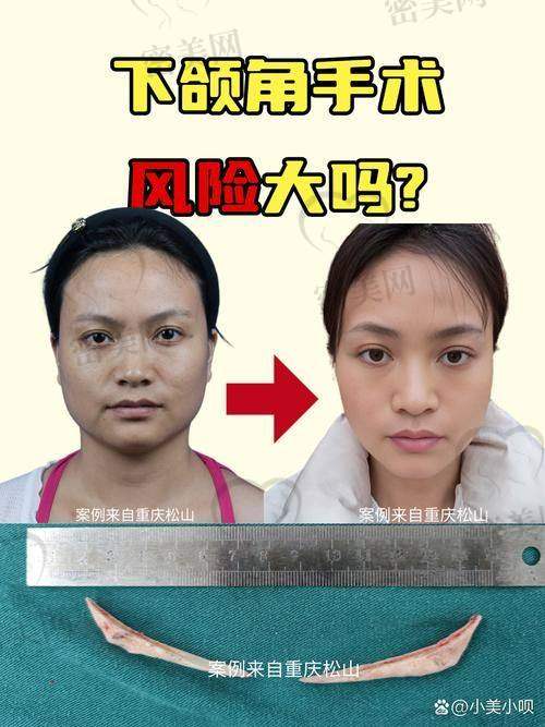 上海时光何晋龙磨骨多少钱：专精能力杠杠滴