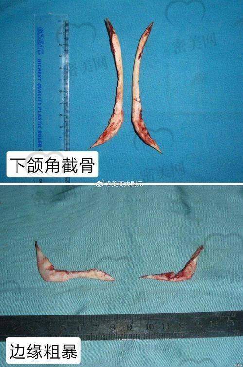 北京嘉禾医疗美容——侯智慧院长主刀