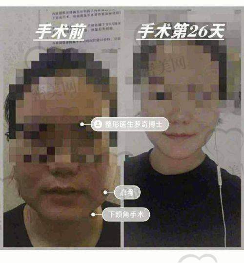 北京京韩医疗美容——吸脂磨骨两不误