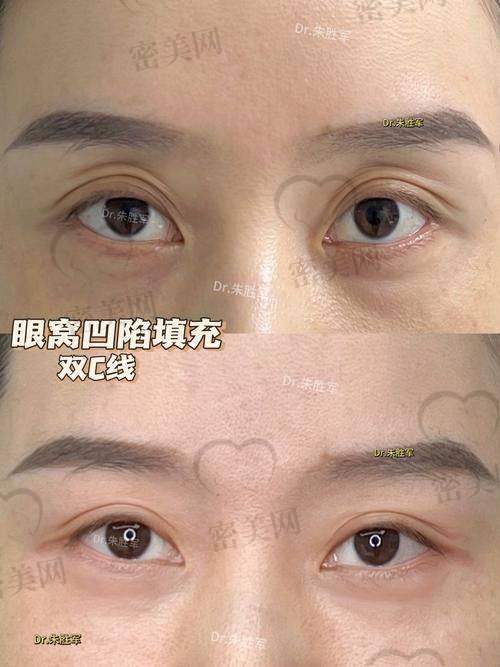 做脂肪填充眼窝前要注意啥？