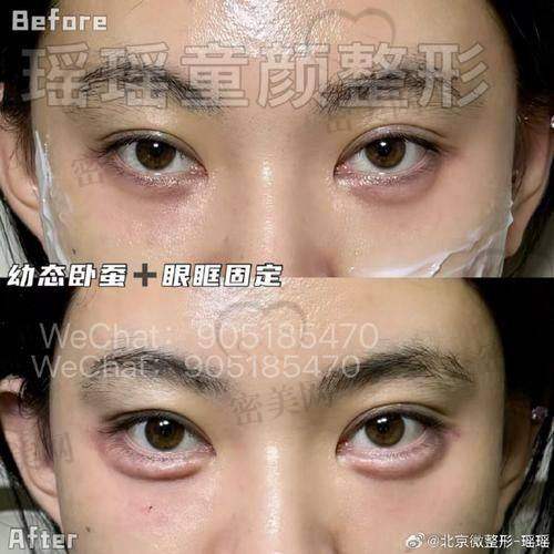 脂肪填充眼窝有啥风险不？