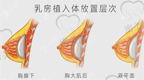 上海艺星整形彭才学：2 - 4w 开启曼托假体隆胸低价盛宴