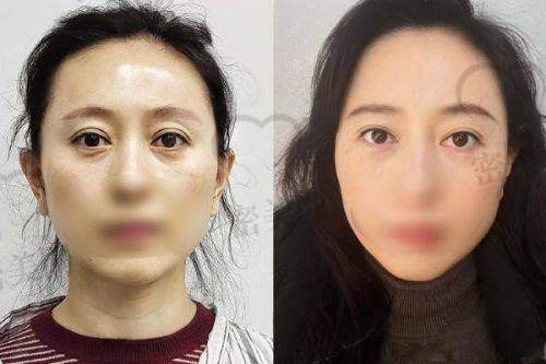 上海艺星许炎龙修复双眼睛怎么样？口碑评价超棒哒