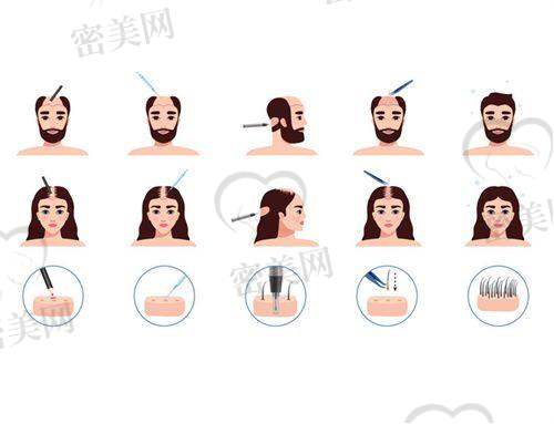 十家成都正规植发医院及地址一览