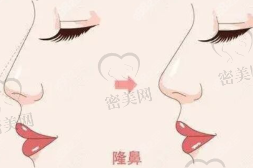 经典隆鼻实例：李建兵医生的杰作