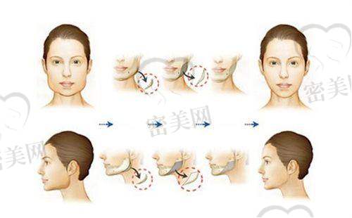 典型实例展示：从“妊娠纹腹”到“紧致马甲线”的真实蜕变