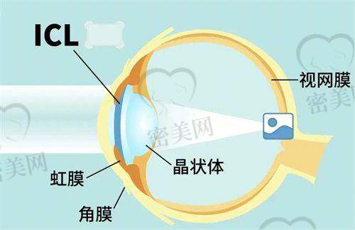 河南省人民医院眼科近视矫正手术价格详解:全飞秒14500元起,ICL植入超3万元
