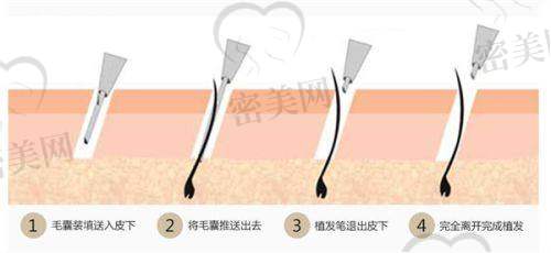 FD - FUE的四大核心维度，突破脱发治疗“天花板”