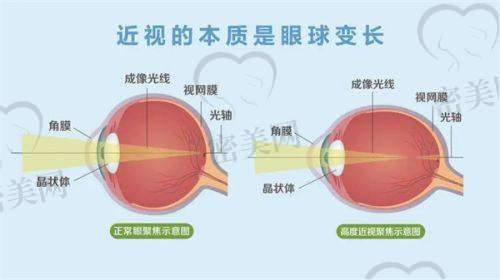 半飞秒&个性化半飞秒激光手术：高性价比的主流矫正方式
