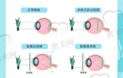 万州爱尔眼科ICL晶体植入手术：价格偏高但优势明显