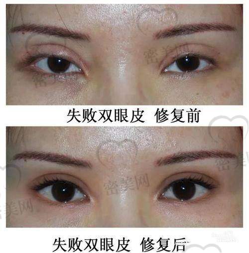 北京晶美魏志香双眼皮修复：技术优势大揭秘