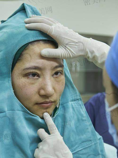 北京晶美魏志香双眼皮修复：开启美丽新征程