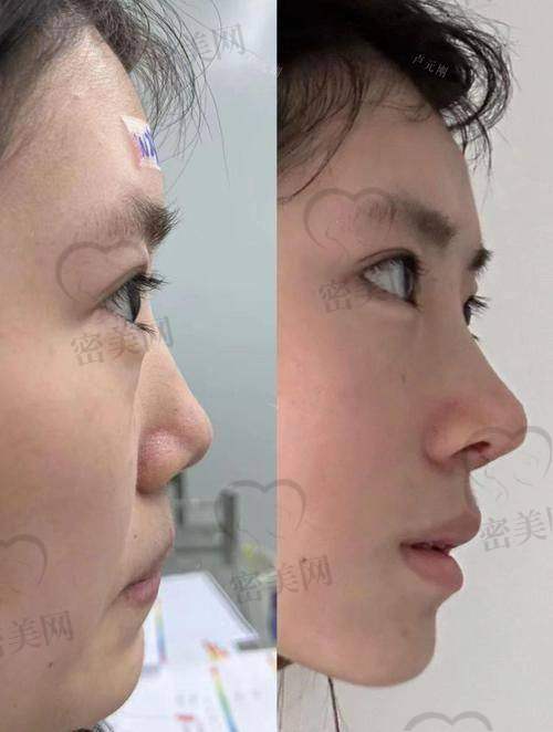 上海伯思立整形王玲做鼻子：口碑爆棚的秘密