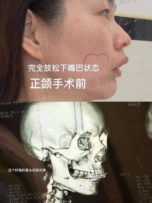 正颌技术风格对比：细腻型 vs 强调整容型