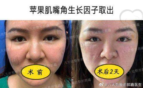 北京臻瑞尚美医疗美容：多点式联合吸附取异术