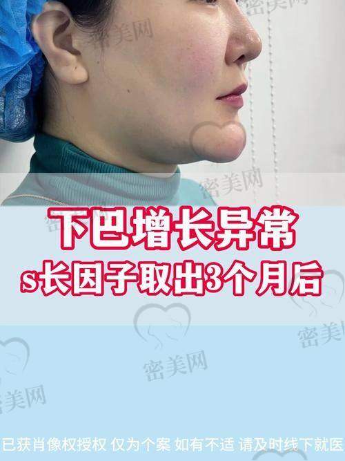 北京爱多邦医疗美容：生长因子+假体包膜专精剥离