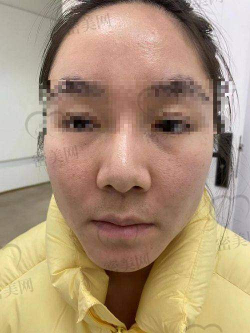 北京原辰医疗美容门诊部：结构型脂肪修复提升术