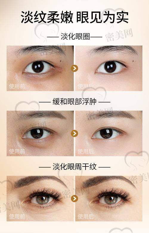 黑眼圈类型怎么选熊猫针剂型？｜医生实用判断指南