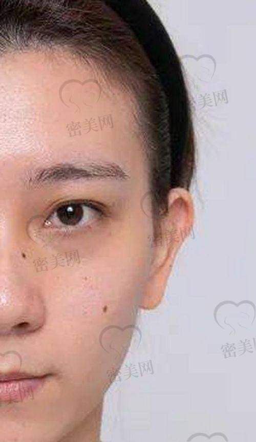 打熊猫针术后注意事项｜不懂护理等于白打