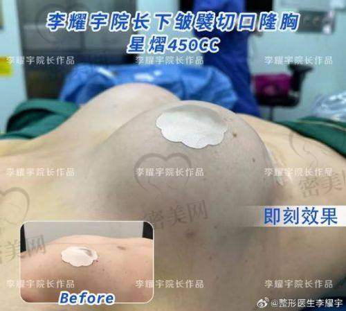 上海艺星整形彭才学傲诺拉假体隆胸：口碑爆棚
