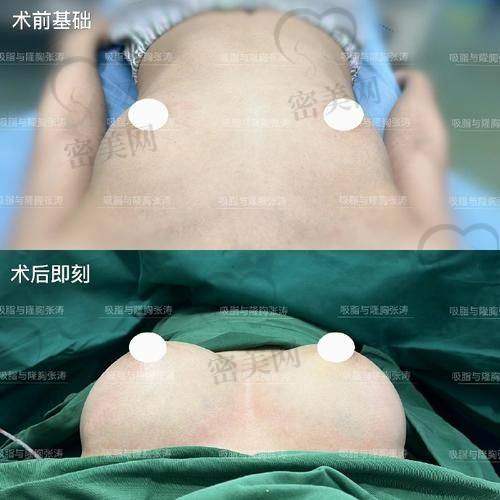 上海艺星整形彭才学曼托假体隆胸：真人实例见证奇迹