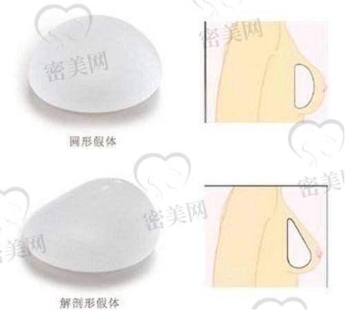上海艺星整形：曼托假体隆胸的理想之选