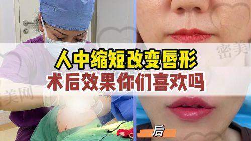 人中整形术后术前常见问题解析
